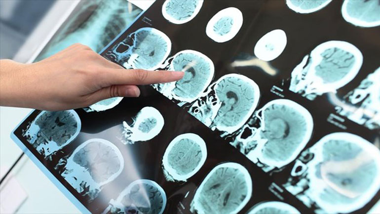 Πρωτοπόροι του Johns Hopkins «μεταφράζουν» την έρευνα για την Alzheimer στην Ελλάδα