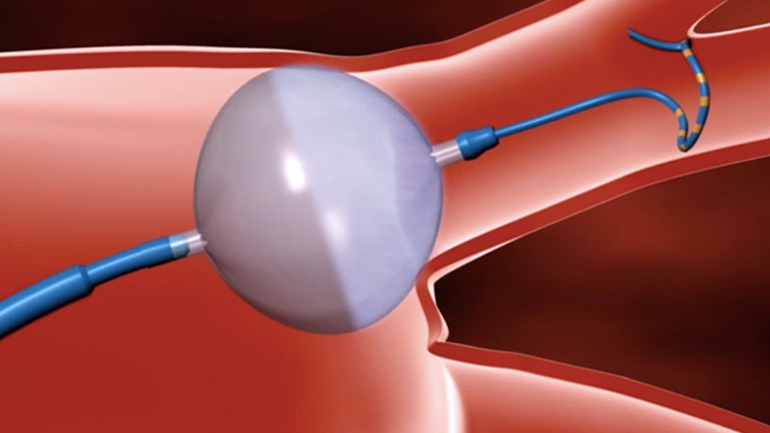 Επεμβατική αντιμετώπιση κολπικής μαρμαρυγής