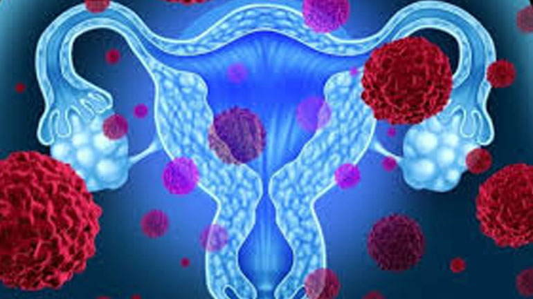 Νέες ελπίδες για τη θεραπεία του καρκίνου ωοθηκών υψηλού κινδύνου