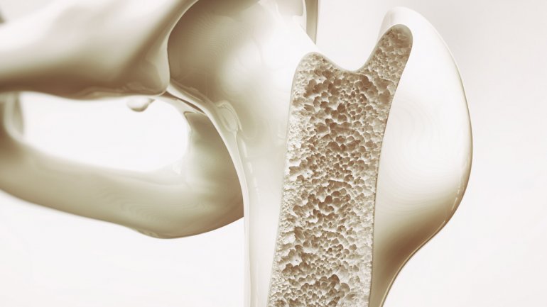 Η οστεοπόρωση συνδέεται με τη χρήση στατινών – Το αποτέλεσμα εξαρτάται από τη δοσολογία