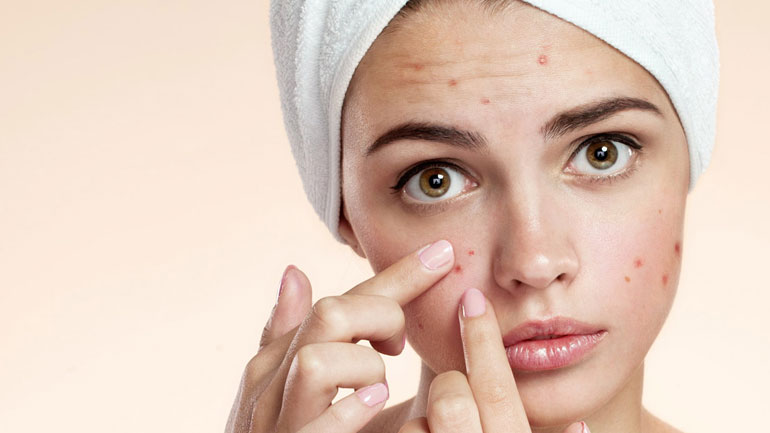 Η εμφάνιση της ακμής συνδέεται με κακές διατροφικές συνήθειες