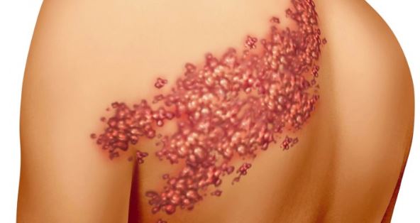 Έρπητας Ζωστήρας: H νόσος, τα συμπτώματα, η πρόληψη