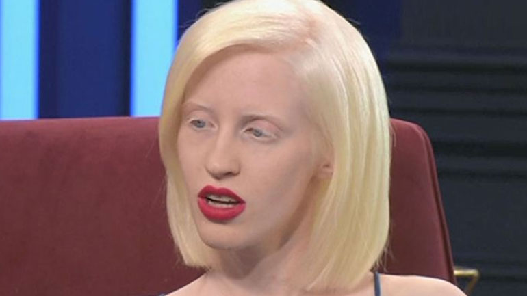 Ανδριανή Ζαχάρη: Το μοντέλο με Αλφισμό μιλάει για τον ρατσισμό και το μόντελινγκ