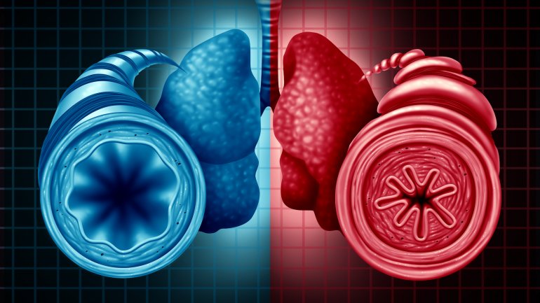 Για πρώτη φορά, οι επιστήμονες βρήκαν ότι το λίπος μπορεί να φράξει τους αεραγωγούς, όχι μόνο τις αρτηρίες