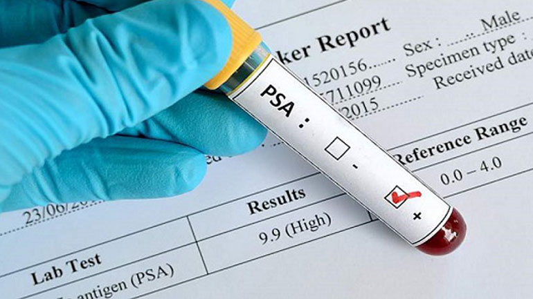 Οι άνδρες με υψηλή τεστοστερόνη κινδυνεύουν περισσότερο από καρκίνο του προστάτη