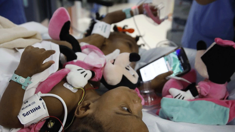 Γαλλία: Επιτυχημένη επέμβαση διαχωρισμού σιαμαίων κοριτσιών