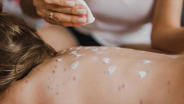 Σαμόα: Τουλάχιστον 20 νεκροί από την επιδημία ιλαράς στη χώρα