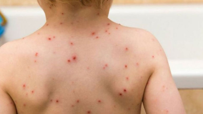 Τους 42 έχουν φθάσει οι νεκροί λόγω ιλαράς στη Σαμόα