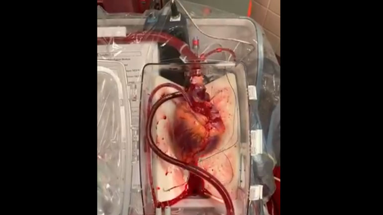 ΗΠΑ: Έκαναν μεταμόσχευση καρδιάς από νεκρό δότη