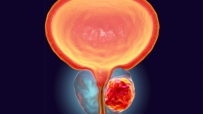 Η άσκηση μειώνει τον κίνδυνο καρκίνου του προστάτη