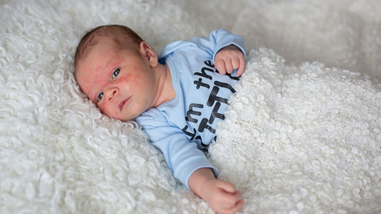 Ο χειμώνας «θρέφει» το έκζεμα στα παιδιά