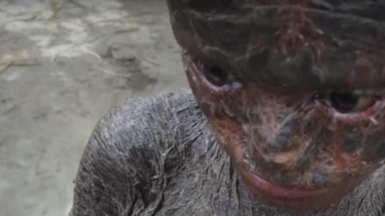 Συγκλονιστικές εικόνες: Το αγόρι – φίδι αλλάζει το δέρμα του κάθε μήνα