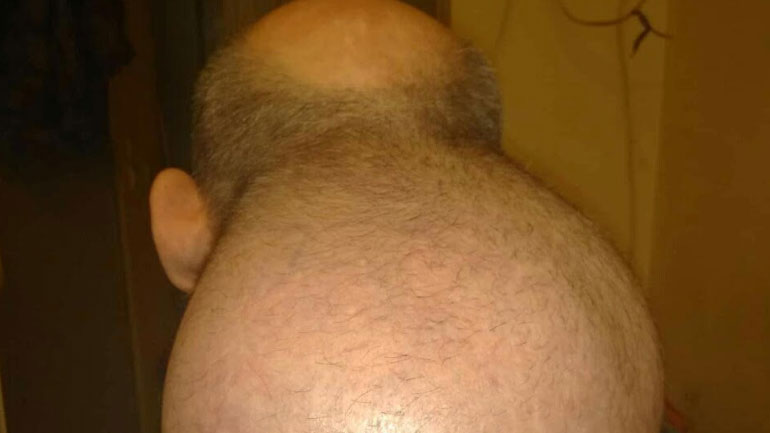 Κρατούμενος στις φυλακές Νιγρίτας εκπέμπει SOS- «Έβγαλα 2ο κεφάλι»