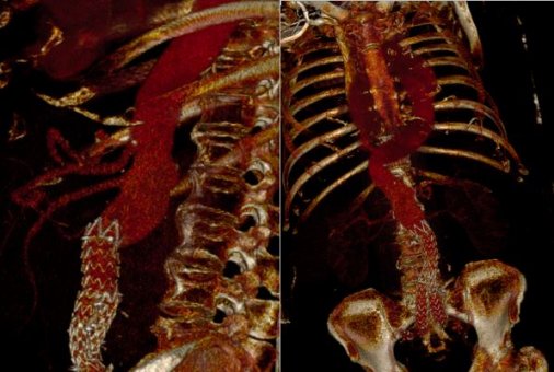 Προεγχειρητικές εικόνες αξονικής αγγειογραφίας με το παλιό μόσχευμα