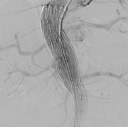 Διεγχειρητική τελική αγγειογραφία με τη «γεφύρωση» του θυριδωτού με το παλιό μόσχευμα και τα 4 σπλαχνικά αγγεία (κοιλιακή, άνω μεσεντέρια αρτηρία και τις 2 νεφρικές αρτηρίες).