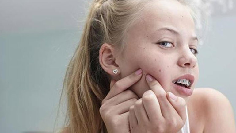 Πώς να βοηθήσετε το παιδί σας να αντιμετωπίσει την ακμή