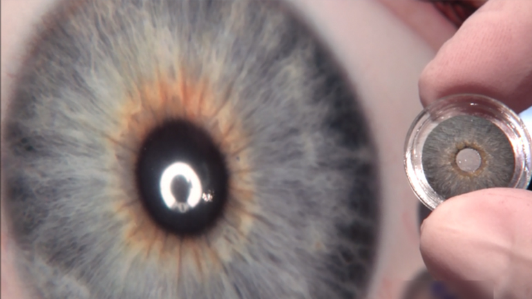 Τοποθέτηση τεχνητής ίριδας για πρώτη φορά στην Ελλάδα σε νοσοκομείο της Κέρκυρας