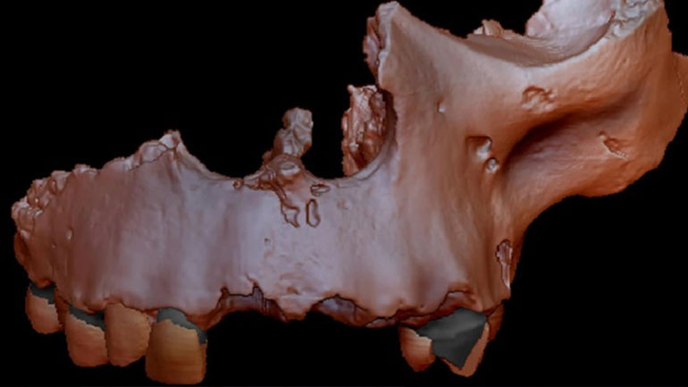 Το αρχαιότερο στον κόσμο ανθρώπινο γενετικό υλικό βρέθηκε στα δόντια ενός κανίβαλου Homo antecessor