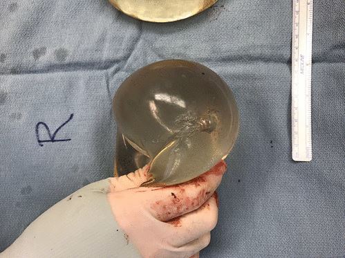 Το εμφύτευμα σιλικόνης συγκράτησε την σφαίρα που εξοστρακίστηκε 