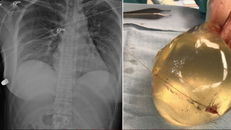 Απίστευτο: Σώθηκε από πυροβολισμό χάρη στα εμφυτεύματα σιλικόνης στο στήθος