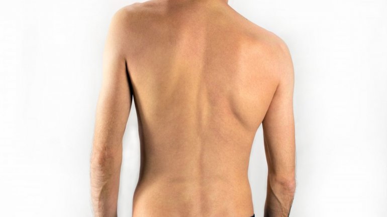 Τα πλεονεκτήματα της χειρουργικής αντιμετώπισης της σκολίωσης και της κύφωσης με το ρομποτικό σύστημα ExcelsiusGPS