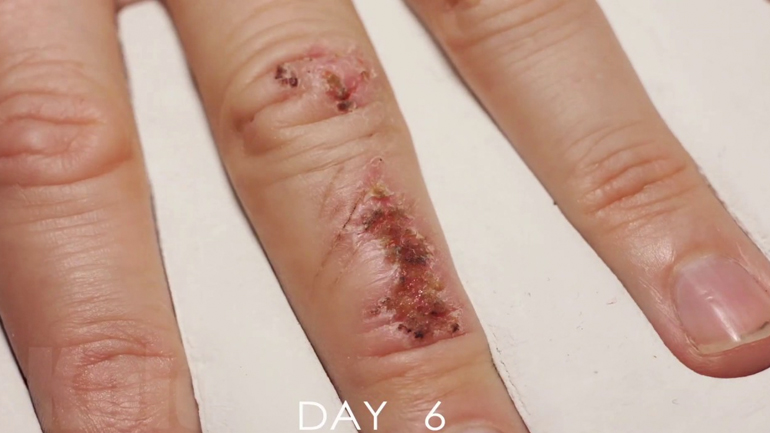 TimeLapse: 33 ημέρες θεραπείας