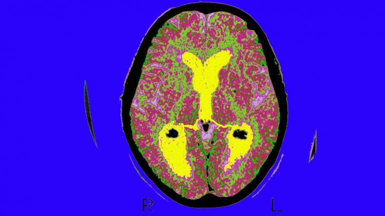Υδροκέφαλος: Ο αφανής σύμμαχος της άνοιας!