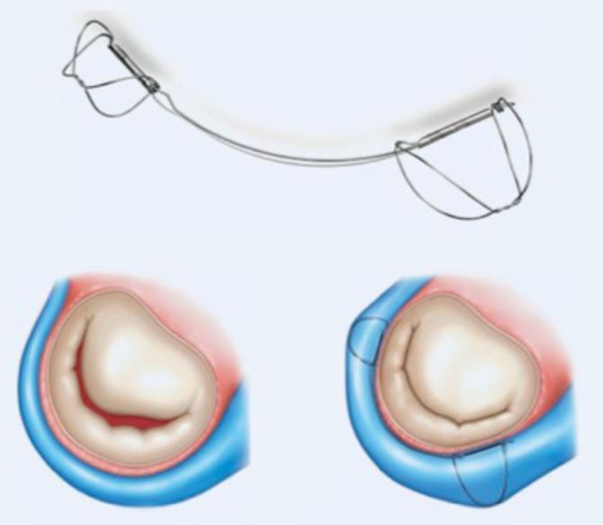 Αριστερά: Πριν την εμφύτευση της συσκευής Carillon: διάταση του μιτροειδικού δακτυλίου-ανεπαρκής σύγκλειση της βαλβίδας. Δεξιά: Μετά την εμφύτευση της συσκευής Carillon: αναδιαμόρφωση του μιτροειδικού δακτυλίου-επαρκής σύγκλειση της βαλβίδας.
