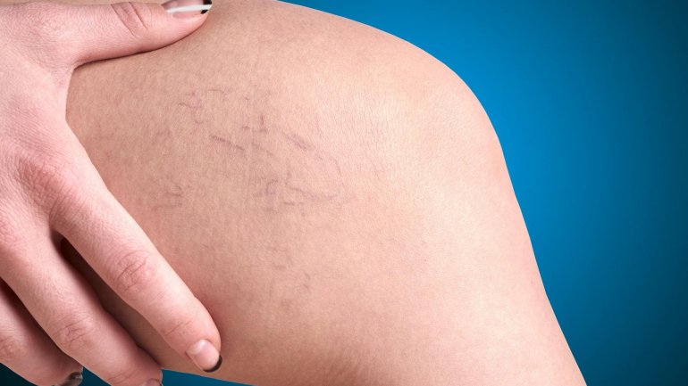 Αναίμακτη & ανώδυνη θεραπεία των κιρσών