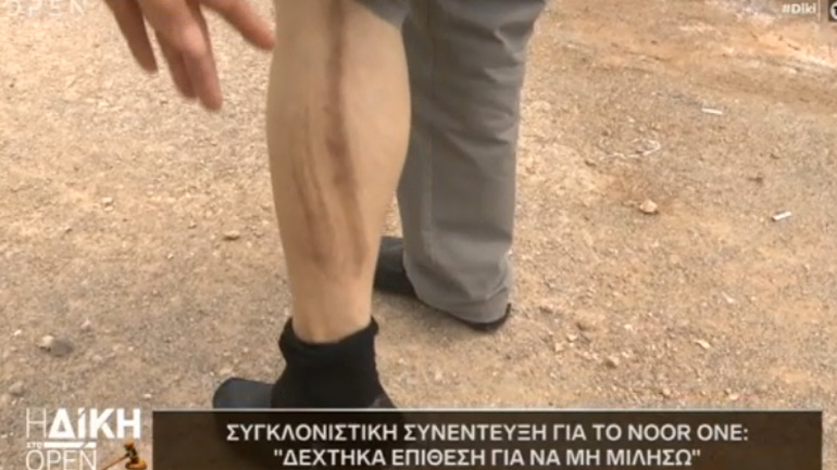 Τα σημάδια στο πόδι από τη δολοφονική επίθεση, που όπως υποστηρίζει δέχτηκε από έξι άτομα