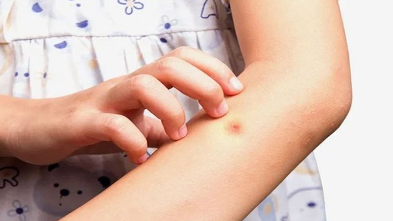 Τι πρέπει να κάνετε αν τσιμπήσει κάποιο έντομο το παιδί σας;