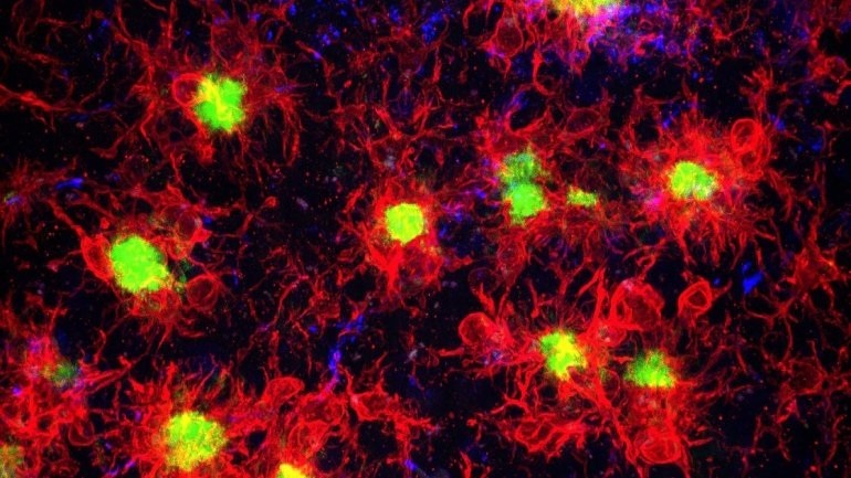 Ευρήματα εμμένουσας μυοκαρδιακής βλάβης σε ασθενείς που ανέρρωσαν από COVID-19