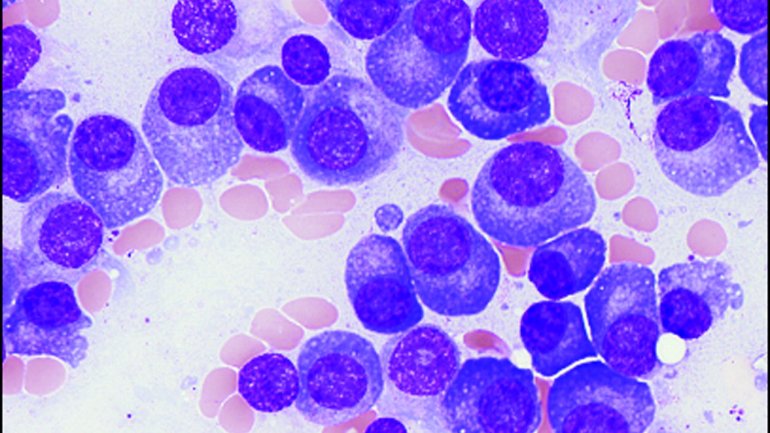 Νέα έγκριση συνδυαστικής θεραπείας για ασθενείς με πολλαπλό μυέλωμα από τον FDA