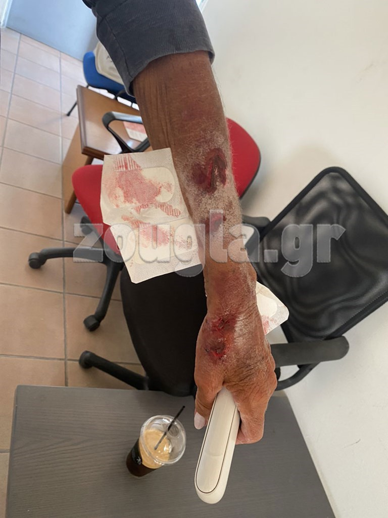 Ο τραυματισμός της κυρίας από τον νεαρό Ιταλό.