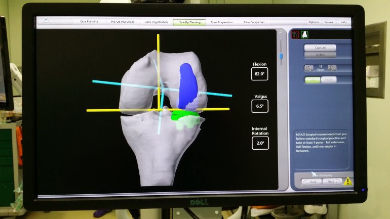 Nέα τεχνική ολικής αρθροπλαστικής γόνατος με προεγχειρητική πλοήγηση οδηγών (preoperative navigation guides)