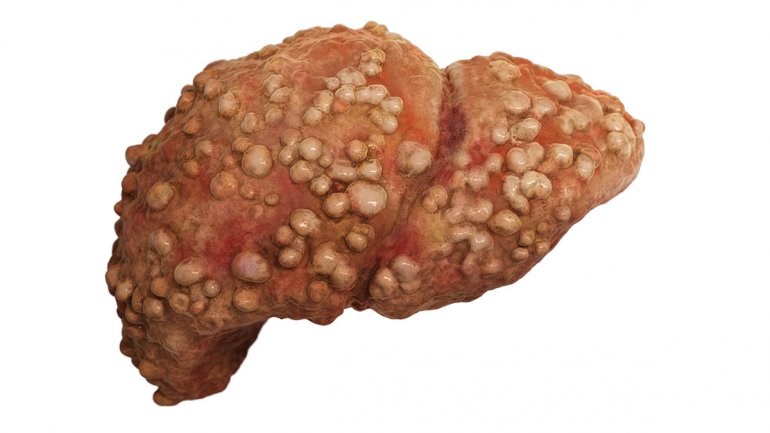 Η σωστή διατροφή και η φυσική άσκηση μπορούν να προλάβουν τον καρκίνο του ήπατος και την στεατοηπατίτιδα