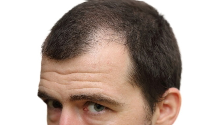 Η πανδημία προκαλεί και… τριχόπτωση