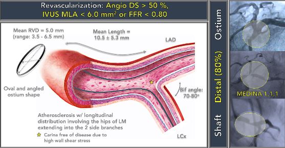 Κατανομή νόσου στελέχους και κριτήρια σημαντικότητας για διαδερμική αγγειοπλαστική.