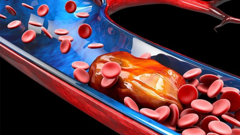 Aσθενείς με COVID-19 διατρέχουν αυξημένο κίνδυνο εμφάνισης δυνητικά θανατηφόρων θρόμβων αίματος