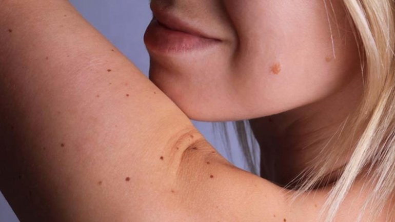 Aνάγκη ένταξης του καρκίνου του δέρματος στις επαγγελματικές ασθένειες