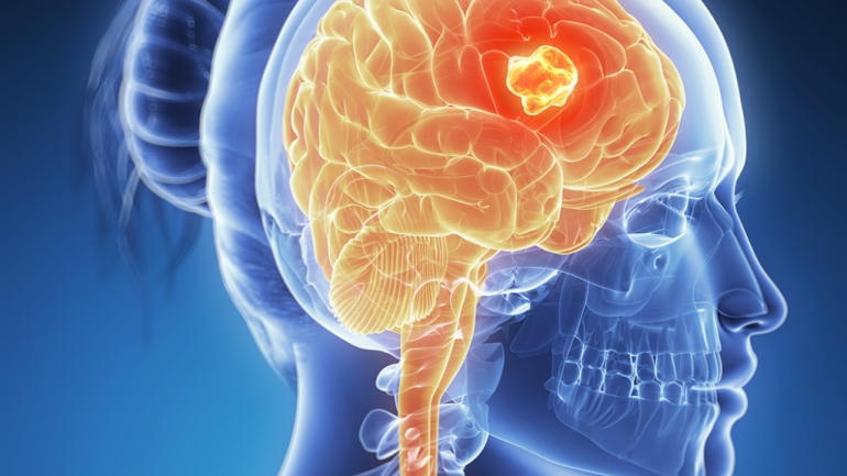 Κακοήθεις όγκοι εγκεφάλου: Όταν “λάμπουν” έχουν διπλάσια πιθανότητα ολικής αφαίρεσης και καλύτερη πρόγνωση