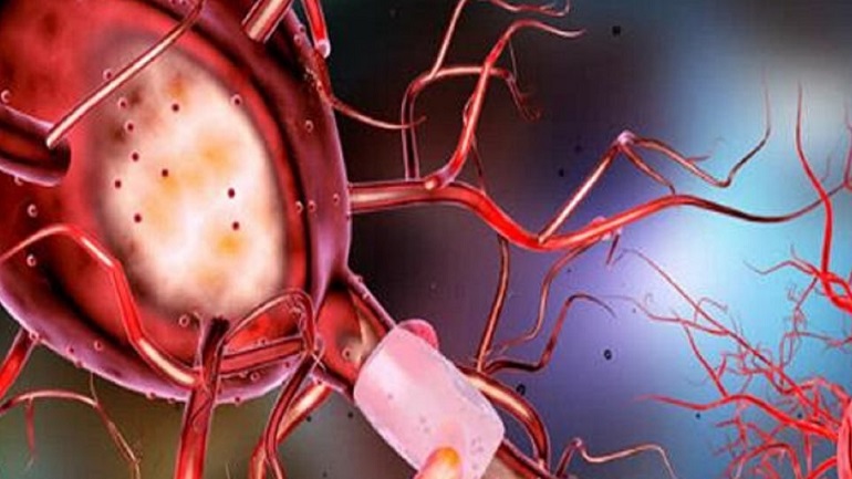 Έρευνα: Η ατμοσφαιρική ρύπανση αυξάνει τον κίνδυνο για Αλτσχάιμερ και Πάρκινσον