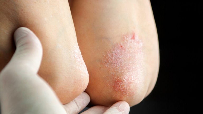 Ψωρίαση: Μια ασθένεια με πολλαπλά πρόσωπα