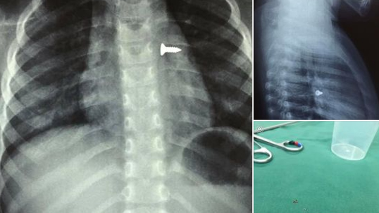 Ηράκλειο: Κοριτσάκι κατάπιε βίδα που κατέληξε στον αριστερό πνεύμονά του