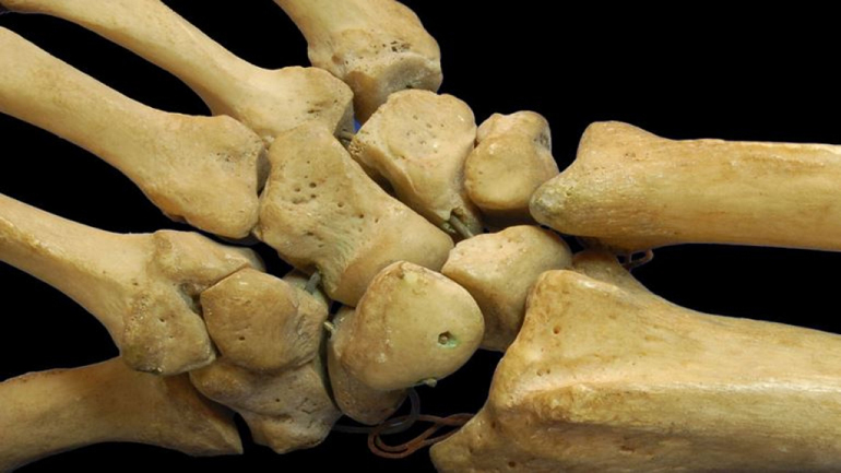 Βρέθηκαν ανθρώπινα οστά στη Σίδερη Θεσπρωτίας