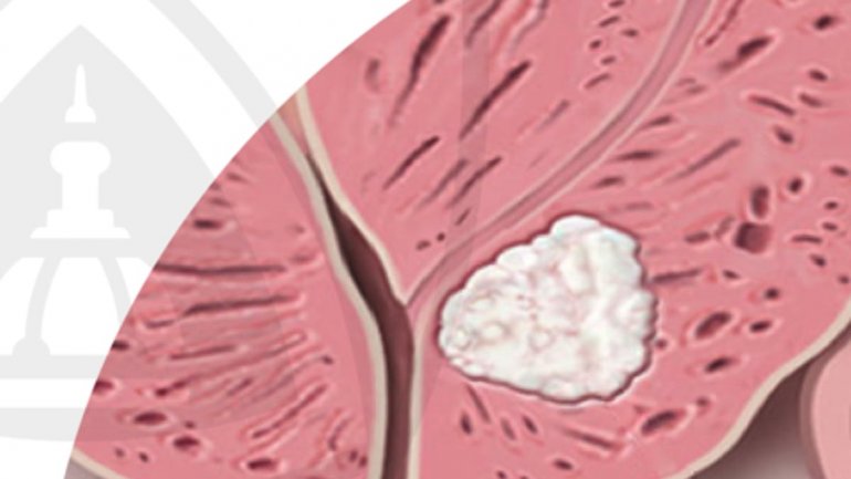 Η θεραπεία των ασθενών με καρκίνο του προστάτη στην εποχή της COVID-19