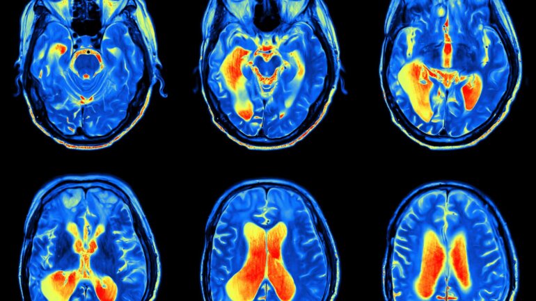 Μελέτη αποκαλύπτει τον ανοσοποιητικό παράγοντα της γήρανσης του εγκεφάλου