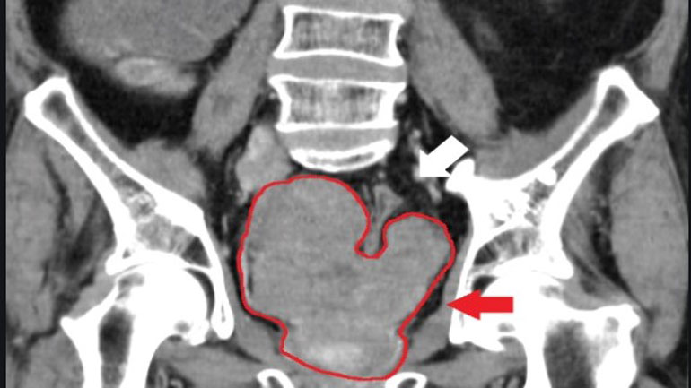 Διάγνωση και σταδιοποίηση του καρκίνου του προστάτη