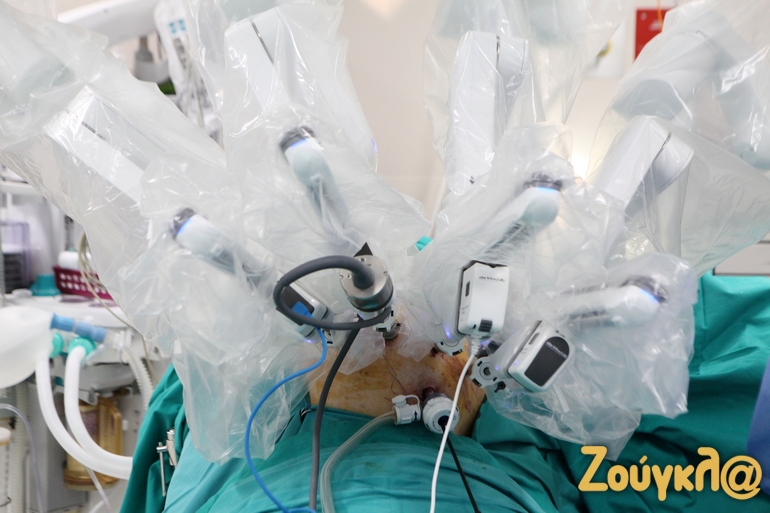 Με το "da Vinci" αποφεύγεται η μεγάλη τομή, καθώς τα όργανα εισέρχονται στο σώμα μέσω ελαχίστων τομών των 5-10 χιλιοστών