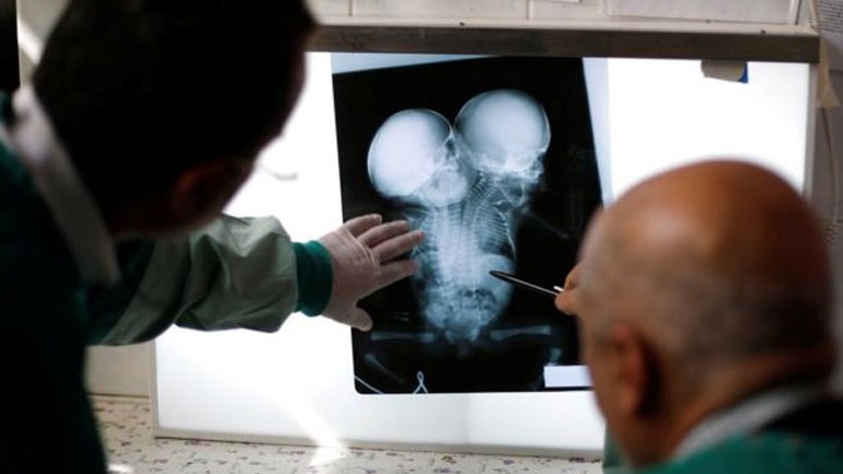 Υεμένη: Σιαμαία σε κρίσιμη κατάσταση διακομίστηκαν στην Ιορδανία για να χειρουργηθούν Υεμένη: Σιαμαία σε κρίσιμη κατάσταση διακομίστηκαν στην Ιορδανία για να χειρουργηθούν